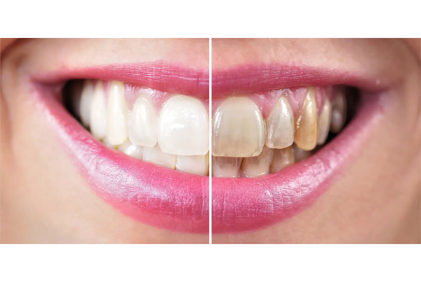 DENTAL RESTORATION